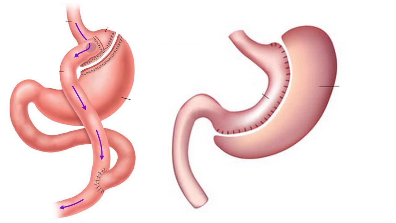 جراحی لاغری- عمل اسلیو معده
