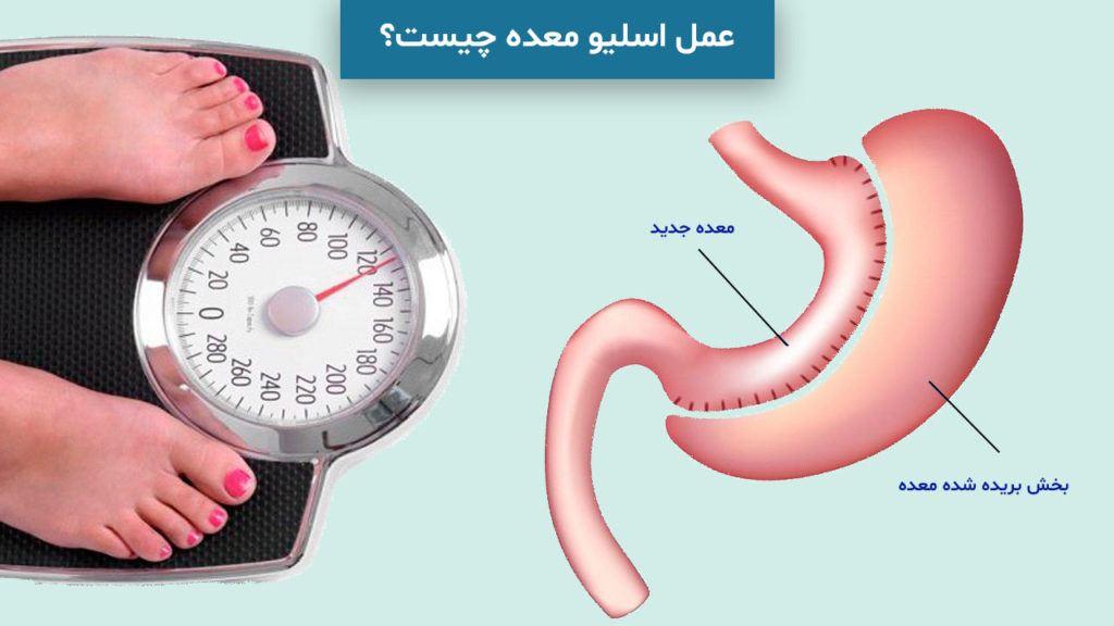 عمل اسلیو معده