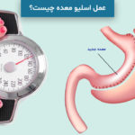 عمل اسلیو معده