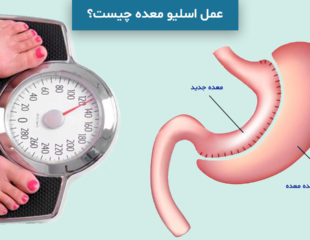 عمل اسلیو معده