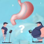 عمل اسلیو معده
