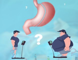 عمل اسلیو معده