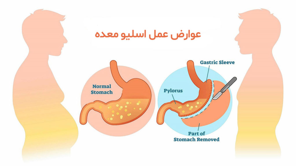 عوارض عمل اسلیو معده