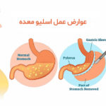 عوارض عمل اسلیو معده