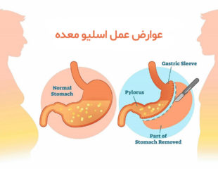 عوارض عمل اسلیو معده