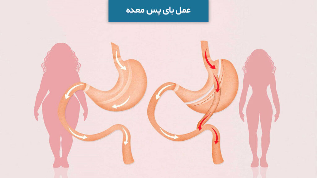 عمل بای پس معده