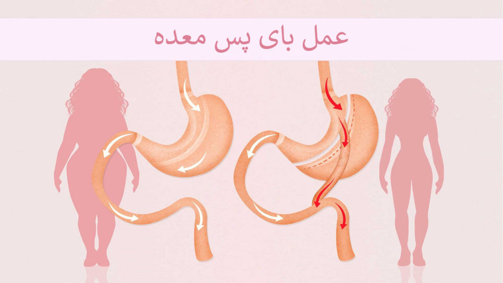 عمل بای پس معده