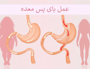 عمل بای پس معده