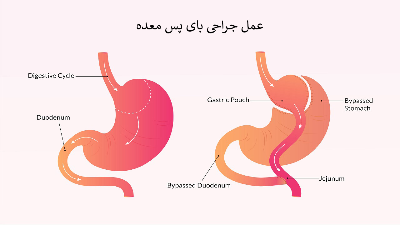 عمل جراحی بای پس معده