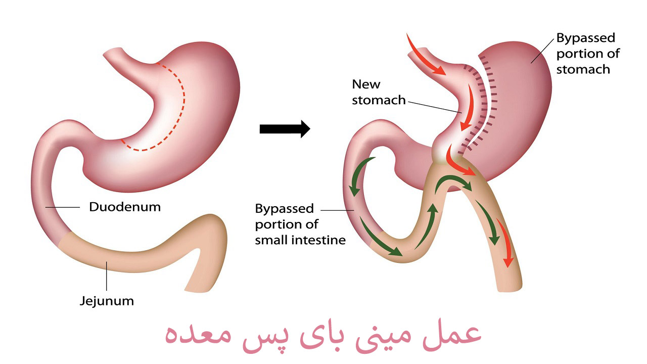 عمل مینی بای پس معده