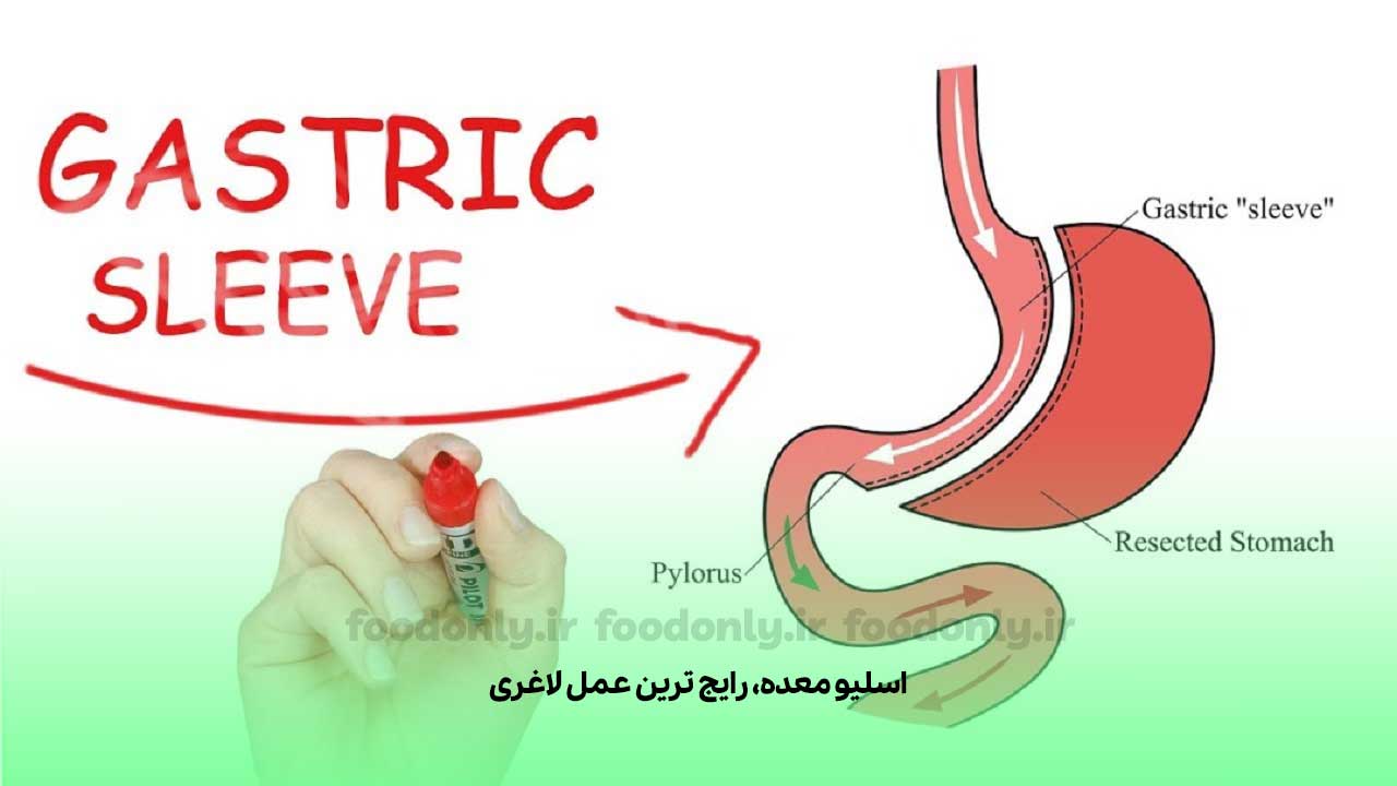 رایج ترین عمل لاغری