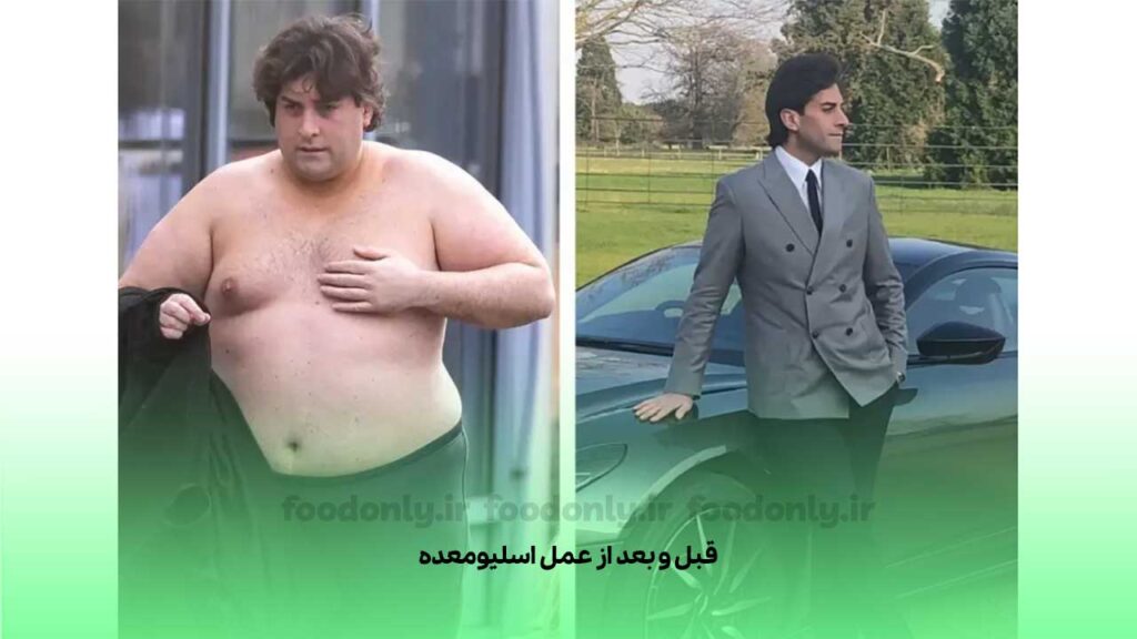 قبل و بعد از عمل اسلیومعده