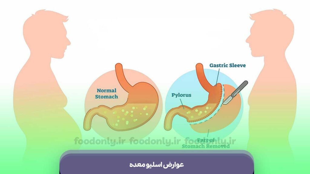عوارض اسلیو معده