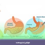 عوارض اسلیو معده