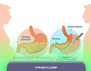 عوارض اسلیو معده