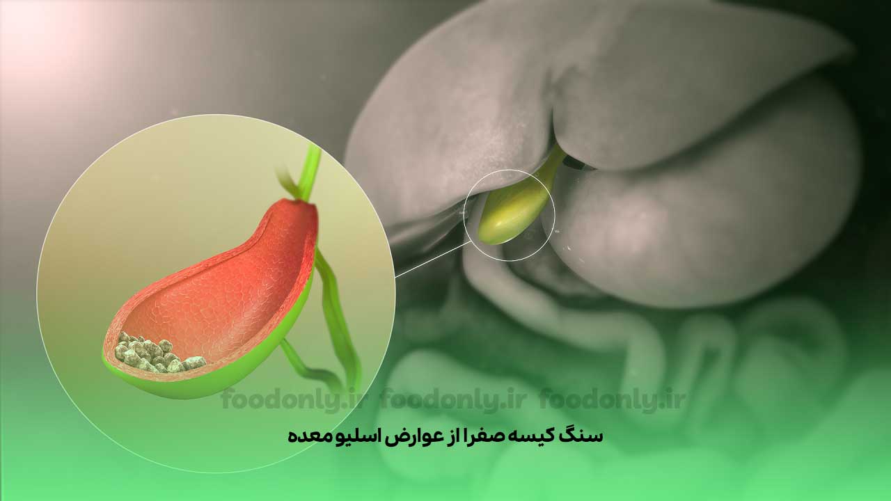 سنگ کیسه صفرا