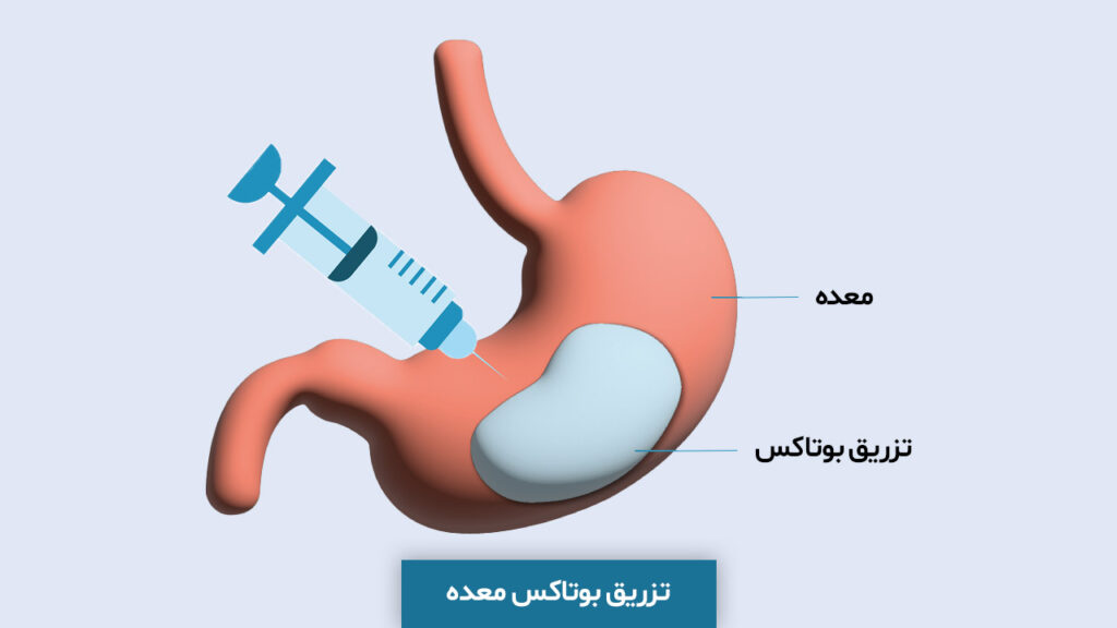 بوتاکس معده