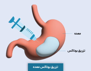 بوتاکس معده