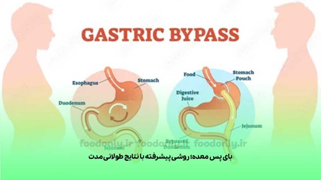 بای پس معده؛ روشی پیشرفته با نتایج طولانی مدت