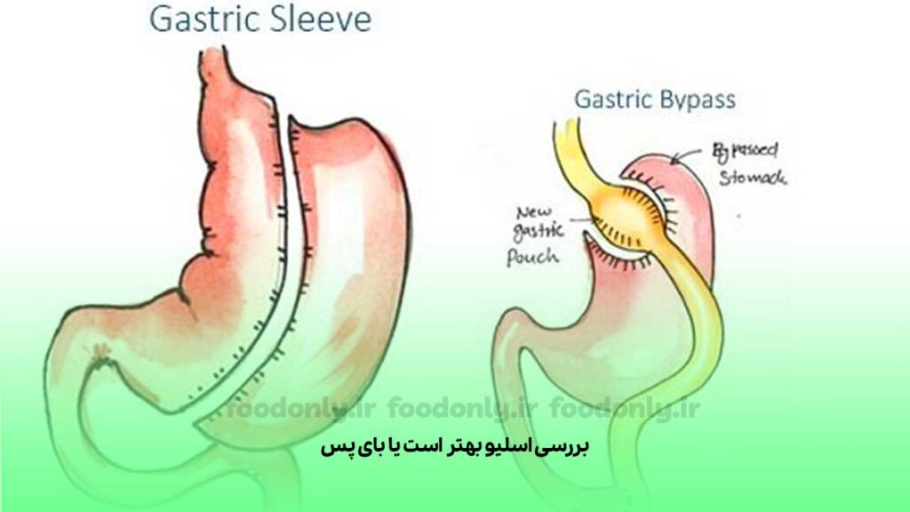 بررسی اسلیو بهتر است یا بای پس