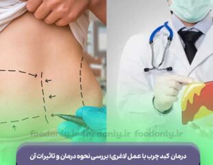 درمان کبد چرب با عمل لاغری