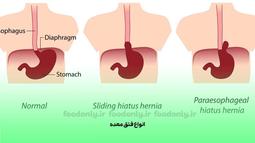 انواع فتق معده