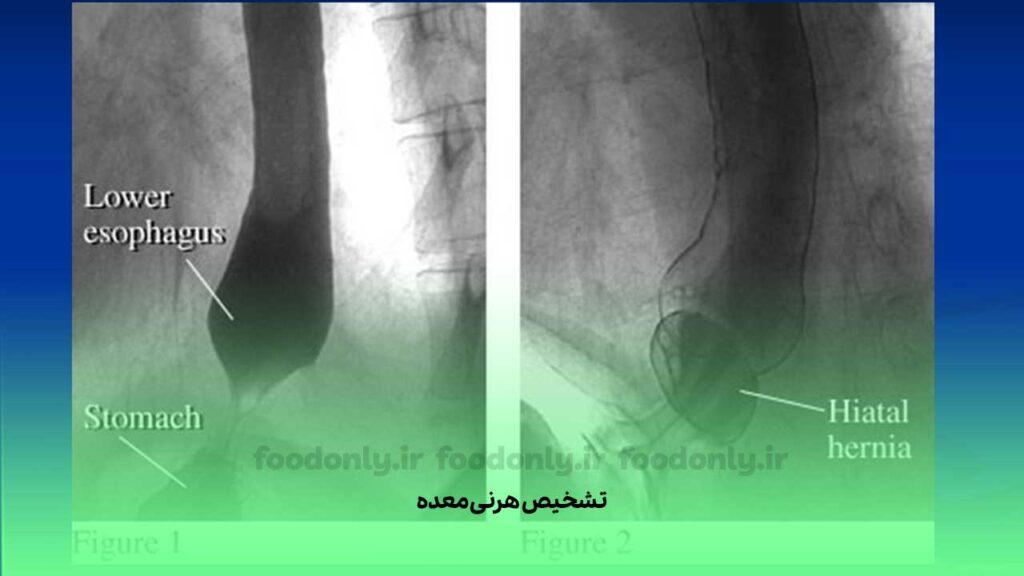 تشخیص فتق معده