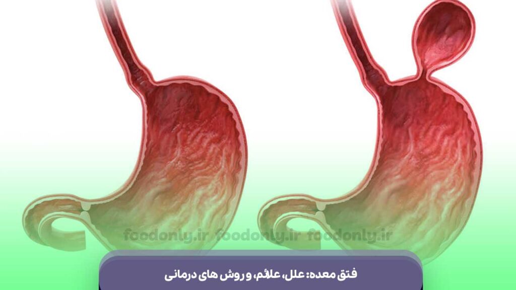 فتق معده