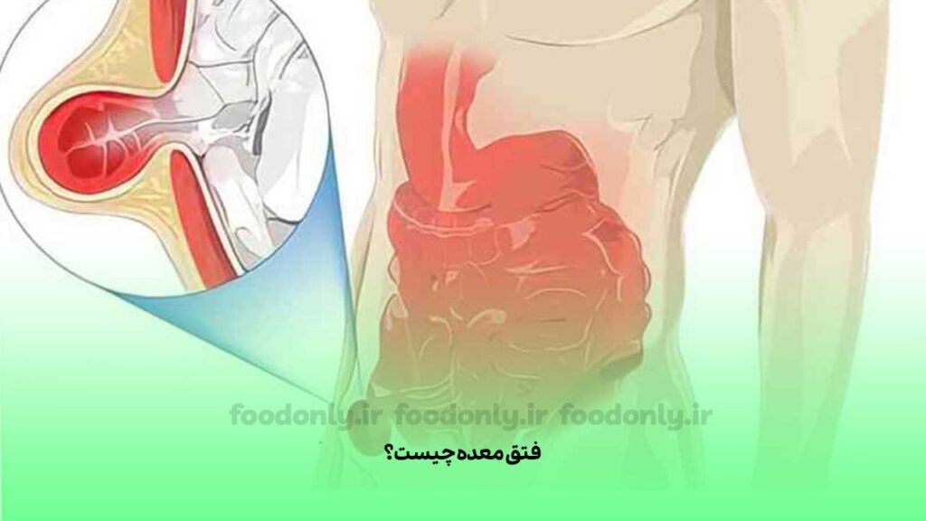 فتق معده چیست؟
