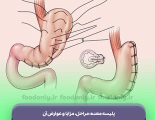 پلیسه معده