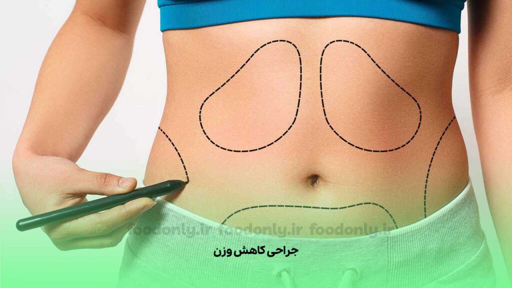 جراحی کاهش وزن آخرین راهکار برای جلوگیری از شدید شدن روند چاقی ارثی