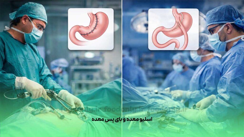 مقایسه هزینه اسلیو معده و بای پس معده